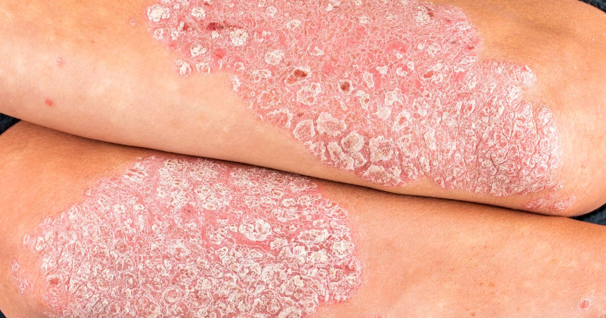 Symptômes et Diagnostic du Psoriasis